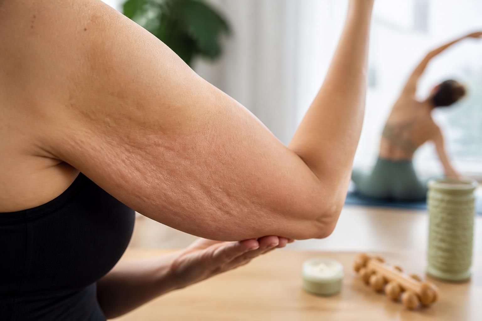 découvrez les causes de la cellulite sur les bras et explorez des solutions efficaces pour l’éliminer, retrouver une peau lisse et tonique.